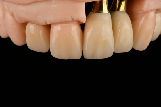Titanium Sandblasted Single Tooth Replacement Implant Dengan Gamma Irradiation Sterilisasi