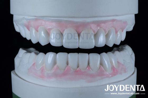 Restorasi gigi yang sangat akurat Wax Up dalam kedokteran gigi 1-2mm Ketebalan
