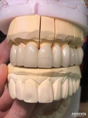Precision Fit Porselen Dipecat ke Logam PFM Mahkota tanpa jahitan Enhancement Natural Smile