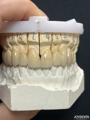 PFM Porselen Fused Metal Crown Untuk Restorasi Biokompatibel jangka panjang