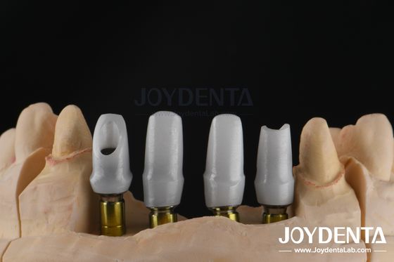 Implan Gigi Custom Zirconia Abutment Untuk Restorasi Unit Tunggal atau Multiple