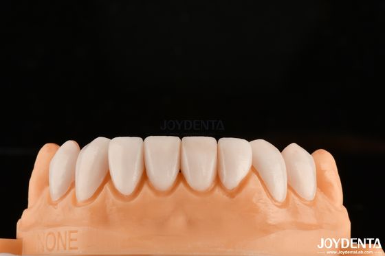 Ikatan yang kuat dengan enamel gigi untuk aman fit veneers gigi kustomisasi untuk nuansa pribadi untuk mencocokkan gigi alami