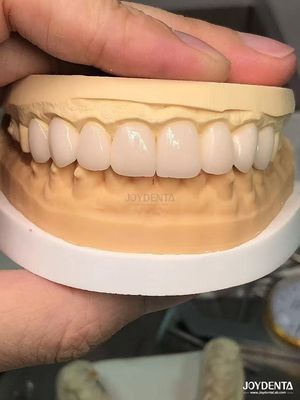 Warna yang disesuaikan untuk mencocokkan gigi alami Biokompatibel dan tahan noda veneer gigi