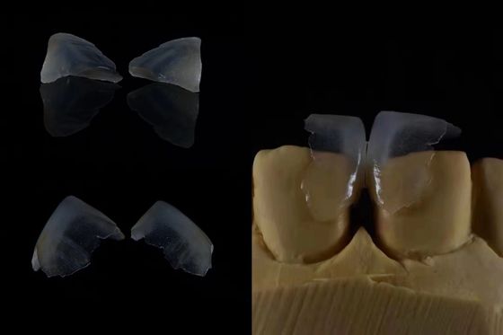 Veneer Gigi Nyaman Ikatan Kuat Dengan Enamel Gigi Untuk Pas Aman Ringan Dan Lemes Untuk Nyaman Pasien yang Optimal