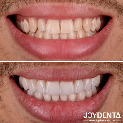 Perfect Fit Porcelain Teeth Veneers Transparansi alami Laminate veneers gigi