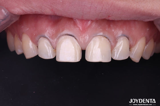 Benar-benar terlihat veneers gigi porselen sangat cocok veneers gigi keramik untuk gigi depan