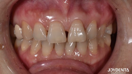 0.5mm Ketebalan keramik veneers gigi alami mencari gigi depan indikasi