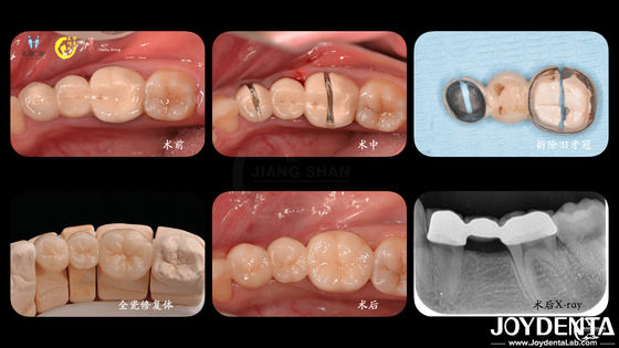 Tailored Dental Zirconia Crown Biokompatibilitas kenyamanan kustomisasi untuk pengalaman pasien yang optimal