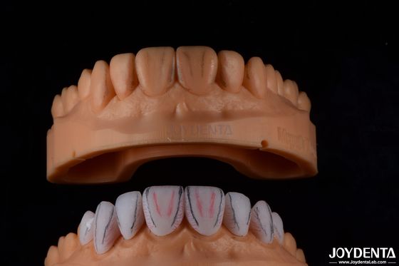 Custom Made Dental Emax Ceramic Veneers Dengan Resistensi noda Gloss Tinggi