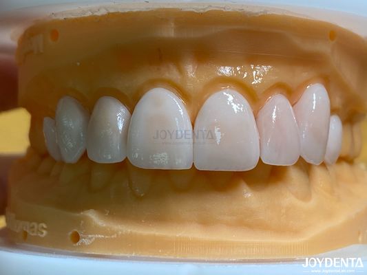 Permeabilitas Tinggi Veneers terlihat alami Veneers Porselen Emax Disesuaikan