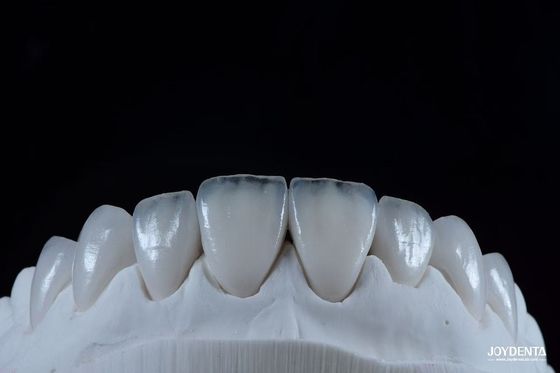 Penampilan Alam Emax Porselen Veneer Nyaman Pas Ultra Thin Emax Veneers