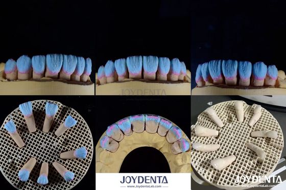 Biokompatibilitas Tinggi Feldspathic Ceramic Veneer Glossy Untuk Restorasi Gigi
