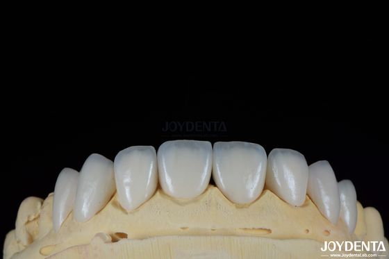 Tekstur Permukaan Glossy Feldspathic Veneer Natural Looking Porcelain Veneer