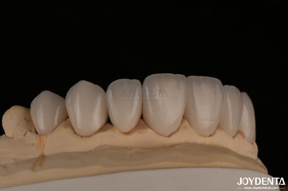 Feldspathic Penampilan alami veneers kosmetik Pas tepat Translucent tinggi