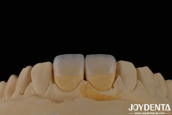 Lengan Dental Feldspathic Veneer Alam Warna Gigi Penampilan Translucent