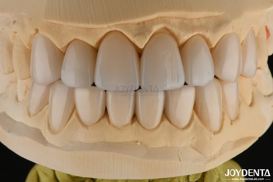0.3-0.5mm tebal Feldspathic Porselen veneer tahan fraktur tinggi meningkatkan senyum Anda