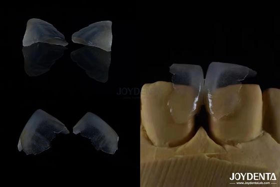 Minimal Invasif Kosmetik Dental Veneers Kaca Keramik Warna ultra tipis