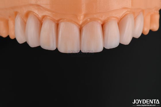 Kaca keramik veneer yang dapat disesuaikan terlihat alami ketahanan kimia yang tinggi