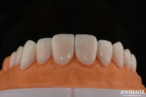A1-A4 Ips Emax Press Porselen Dental Veneers tahan noda Bentuk yang dapat disesuaikan