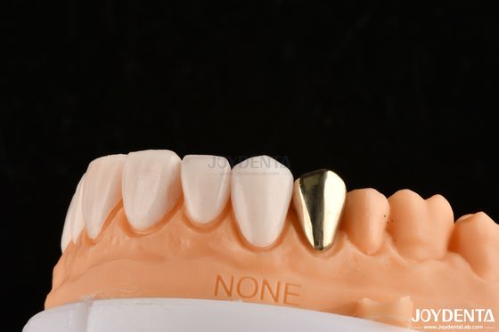 Ultra Thin IPS Emax Press Veneers Veneer Kosmetik Gigi Untuk Restorasi Bagian Depan