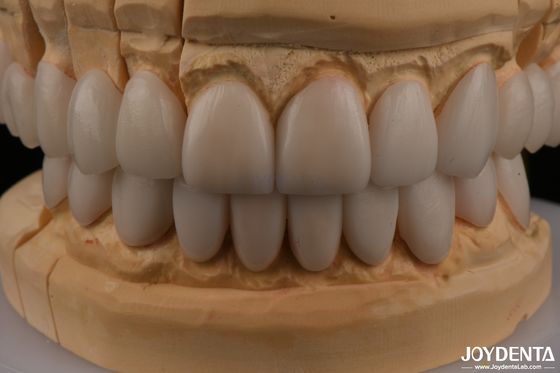 0.3mm Ketebalan Ips Emax Veneers Ceramic Veneers Bagian Depan Bagian Belakang Restorasi