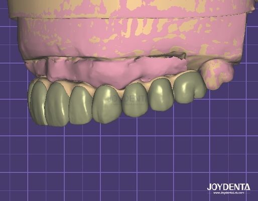HIPAA Selaras Keamanan Data Digital Wax Up Model 3D Untuk Modifikasi Gigi