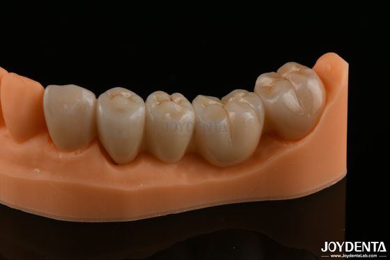 Precision Dental Restorations Full Zirconia Kekuatan Flexural Tinggi Warna alami
