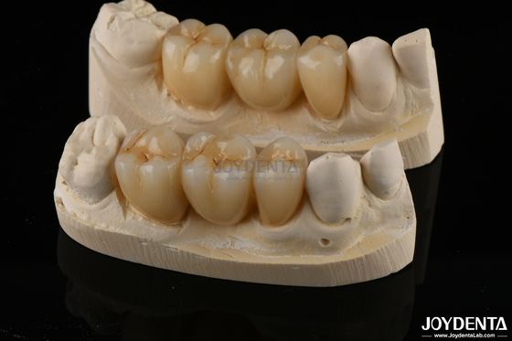 Pakai tahan Zirconia Full Contour Dental Crown Translucence Tinggi