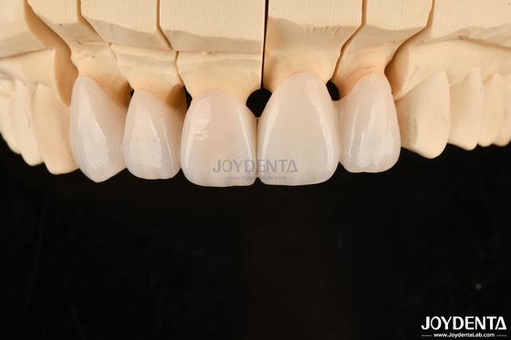 Korona Gigi dan Jembatan Zirconia Berlapis yang Sangat Disesuaikan Solusi Lama