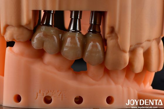 Kekuatan Flexural Tinggi Multilayer Full Zirconia Dental Solution Full Arch Restorasi