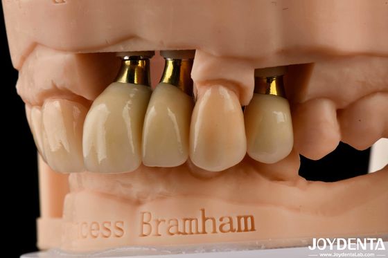 Implan Gigi Precision Mahkota dan Jembatan Solusi yang sempurna untuk senyum yang menyenangkan secara estetis