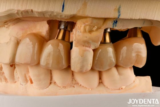 Restoration Of Missing Teeth Implant Crown and Bridge Aman untuk oral dengan fit yang tepat