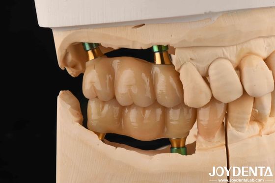 4.5mm Tinggi dipoles internal Hex Abutments Implan Gigi Bentuk V Sekrup Dipertahankan