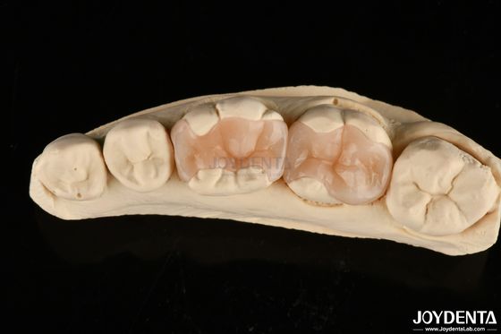 Natural Polymerized Porcelain Dental Inlay Onlay Untuk Restorasi Gigi