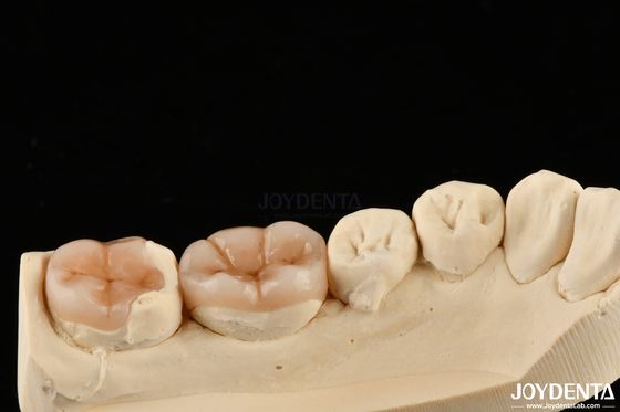 Inlay Onlay Restorasi Gigi dengan Penampilan Alami