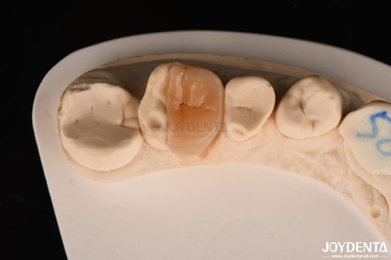 Zirconia Inlay Onlay Dengan Cementasi Adesif Untuk Restorasi Gigi yang Rusak
