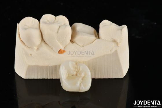 Zirconia Inlays dan Onlays dibuat khusus Restorasi untuk fit yang tak tertandingi dan estetika
