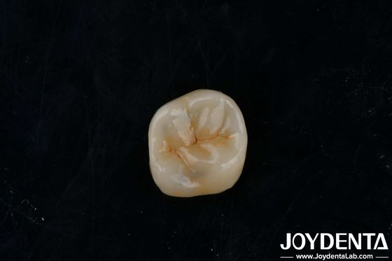 Inlay Zirconia Adhesive Disesuaikan Inlay Translucence Tinggi Untuk Restorasi