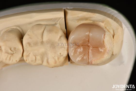 Mudah Bersih Emax Inlays Dan Onlays Hypoallergenic Biocompatible restorasi gigi