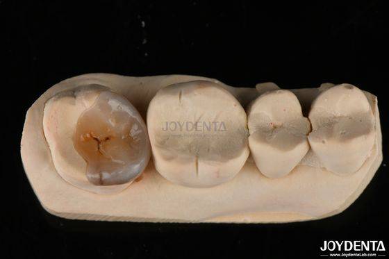 Custom Natural Looking Emax Dental Inlays Dan Onlays Untuk Restorasi Gigi