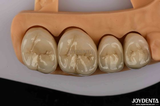 Mahkota Gigi Emas dan Palladium Alloy Premium untuk Ketahanan yang Ditingkatkan