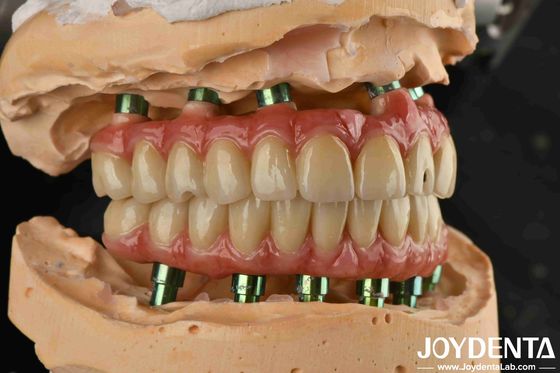 Teknologi hibrida Titanium Malong Dental Bridge Disesuaikan Untuk Hasil Estetika
