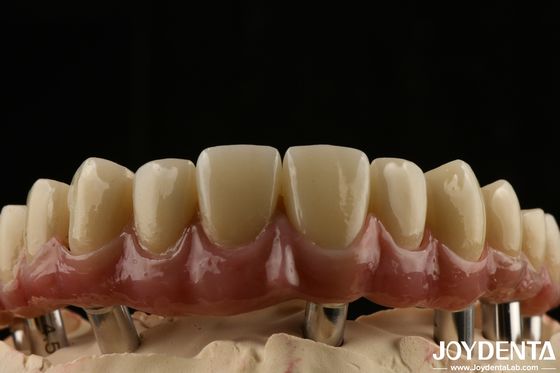 Titanium Malong Dental Hybrid Bridge Panjang Panjang Disesuaikan Fit Densitas Rendah
