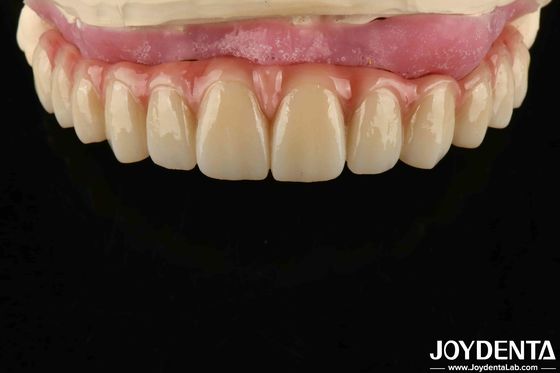 Nyaman Pakai Titanium Malong Hybrid Bridge Dental Desain Disesuaikan Berat Ringan