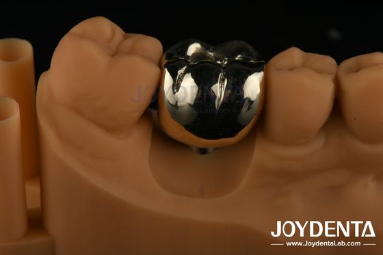 Rehabilitasi Oral Wax Casting FMC Full Metal Crown Untuk Perbaikan Klinis Gigi