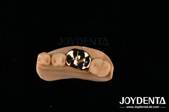 FMC Metallik Perbaikan Klinis Oral Bahan Implan Gigi dengan Ketahanan Abrasif
