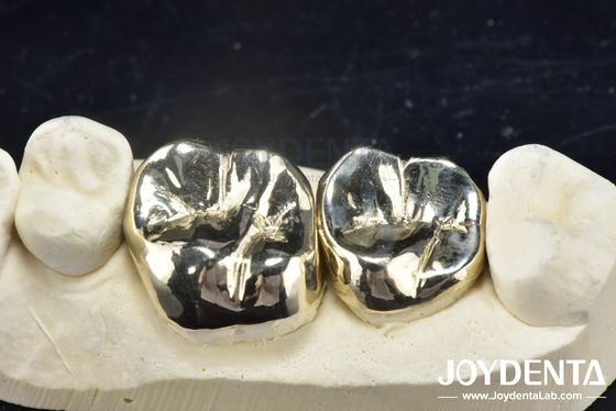 Waxing Casting Dental Repair Full Metal Crown Untuk Rehabilitasi Oral yang Tahan Abrasi