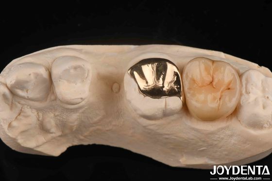 Custom Oral Clinical Wear Resistant Gold Dental Crown Dengan 60K Metallic