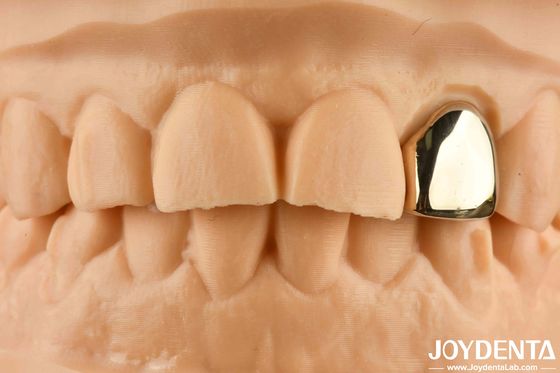 Emas 60K Metal Oral Crown Abrasi Resistant Dental Crown Wax Casting