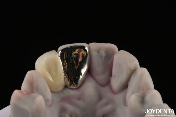Metal Dental Maryland Bridge Fungsi Mengunyah yang Baik Untuk Remediasi yang Lama